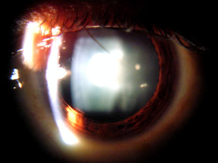 View of an Eye with a Cataract