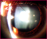 View of an Eye with a Cataract