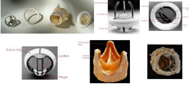 heart valves