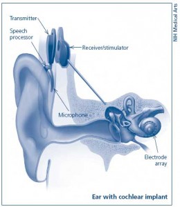 cochlear implant NIH